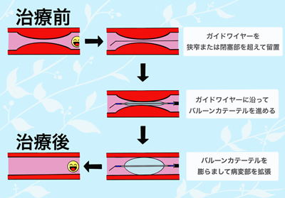 シャントトラブルに対する対応方法